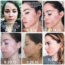 But acne doesn't just affect your skin, it can also affect your quality of life. How I Got Hormonal Acne Under Control Yogabycandace