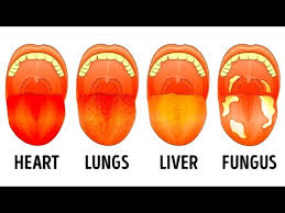 Your Tongue Color Can Reveal At Least 13 Health Problems