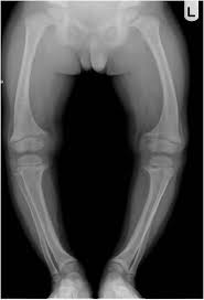 Image result for Genu Varum