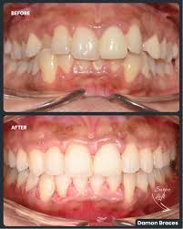 🇫🇷 résultat orthodontique sourire dent canine en place
