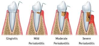 Gingivitis and periodontitis are inflammation of the gums and teeth respectively. Levels Of Periodontitis Dentist On The Green