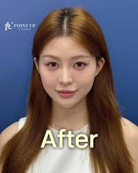 Ear Filler" Is The Latest Plastic Surgery Trend