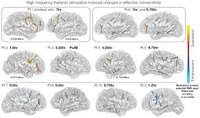 Image result for Thalamic Stimulation
