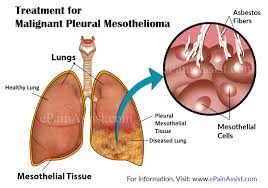 Simple acts like coughing, breathing, and swallowing can cause severe pain, giving the cancer a reputation as one of the most. Malignant Pleural Mesothelioma Treatment Alternative Complementary Therapy