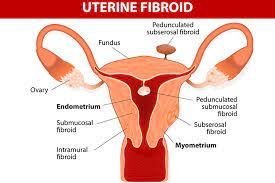 Birth control pills are currently the preferred drug treatment. 5 Best Treatments For Uterine Fibroids During Pregnancy