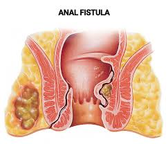 Image result for itchy skin rectum