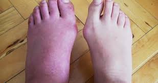 Ayak Sismesinin Nedenleri Nelerdir Ayak Sismesi Nasil Gecer Saglik Haberleri