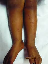 Image result for Papular urticaria