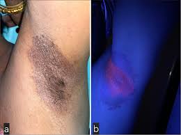 Image result for Erythrasma