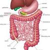 Fetal bowel intrauterine perforation causes sterile inflammation of the peritoneum, known as meconium peritonitis. 1