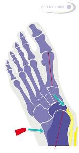 Beim erreichen des gehens weicht bei jedem kind der kalkaneus in valgusstellung ab (physiologischer knicksenkfuß) Knick Senkfuss Hohlfuss Plattfuss Bei Kindern Und Erwachsenen Laufen Lernen Barfuss Laufen Schuh Einlagen Und Operation Www Gelenk Doktor De