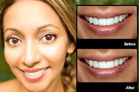 Vu-Test — Best Cosmetic Dentist, Susan Hollar, FAACD, DDS — Arlington, DFW  TX — Restoring Natural Beauty