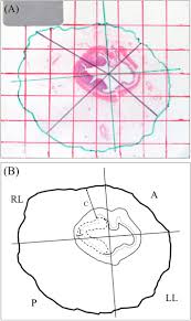 In an invasive carcinoma4, the tumor cells can spread (metastasize) to other parts of your body. Does Circumferential Tumor Location Affect The Circumferential Resection Margin Status In Mid And Low Rectal Cancer Sciencedirect