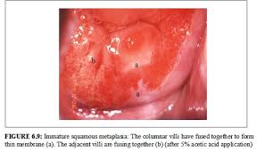 The whole mucosa, including the crypts and the supporting stroma, is displaced in ectropion. Colposcopy And Treatment Of Cervical Intraepithelial Neoplasia A Beginners Manual