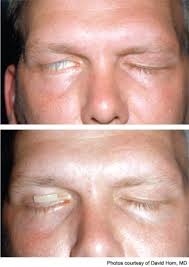 You can always come back for eyelid gold weight cpt code because we update all the latest coupons and special deals weekly. Advances In Facial Paralysis Page 3 Of 5 Enttoday