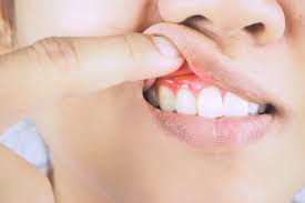 Having healthy gums isn't hard: Tips For Healthy Gums Houston Tamborello Dental Associates