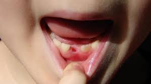 Blue Sky Science How And Why Do Our Teeth Fall Out Science Globegazette Com