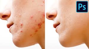 5 Ways To Remove Pimples Fast Youtube