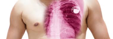 The international classification of diseases (icd) is a globally used diagnostic tool for epidemiology, health management and clinical purposes. Icd Bessert Prognose Bei Idiopathischem Kammerflimmern Medical Tribune