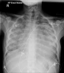 Image result for XRay Changes in Rheumatic Conditions