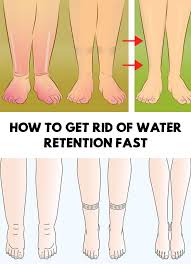 Most Of The Time Swollen Feet And These Inflammations Are Due To Water Retention Find Out How To G Water Retention Remedies Swollen Feet Remedy Foot Remedies