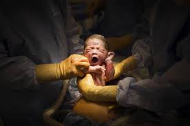 El parto es el momento de la salida del bébé del utero materno. Uno De Cada Cinco Partos En El Mundo Ya Es Por Cesarea Sociedad El Pais