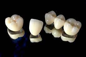 Răng sứ Titan là gì?