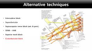 Image result for Superior Trunk Block