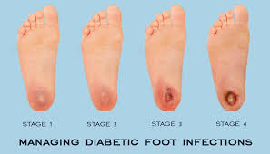 Image result for diabetic toes