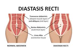 Since most cases of diastasis recti occur in pregnant women, it is a good idea to be mindful of what but you can greatly reduce your chances of seeing your precious abs split in two. Diastasis Recti Causes Of Ab Seperation During And After Pregnancy