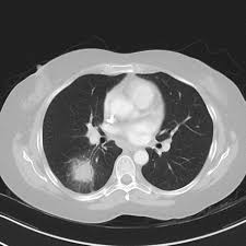 These molds live throughout the environment. Pulmonary Mucormycosis Radiology Reference Article Radiopaedia Org