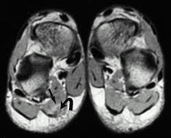 Home » muscles tendons » plantar muscles of the foot. Plantar Fasciitis And Fascial Rupture Mr Imaging Findings In 26 Patients Supplemented With Anatomic Data In Cadavers Radiographics