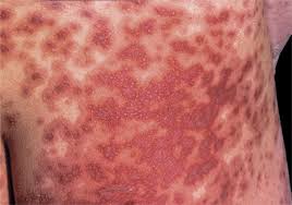 Image result for Generalized Rash