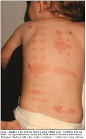 Allergy Testing In Children Which Test When Consultant360