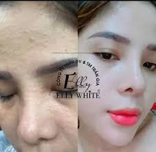 Combo trị nám trắng da Elly white