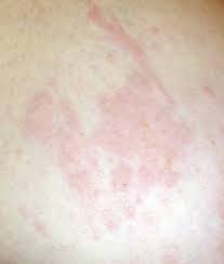 • persistent itching on one breast. Breast Cancer Rash Cancerwalls