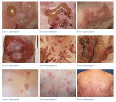 Image result for Pemphigoid