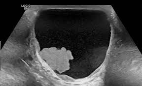 We did not find results for: Paratesticular Mesothelioma Tunica Vaginalis Testis Mesothelioma Body Imaging Teaching Files Uw Radiology