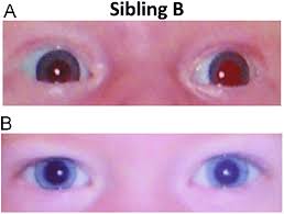 Image result for Mydriasis