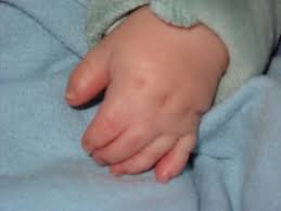 A chest wall deformity and also an abnormality in the hand was noted from this individual. Poland Syndrome
