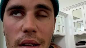 Justin Bieber reveals shocking face paralysis diagnosis to his fans through  Instagram