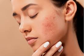 Rosacea Couperose Que Produtos Usar E Cuidados A Ter The Skin Game