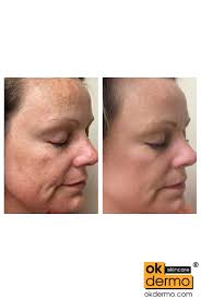 Buy Pure Hydroquinone 4% Cream for Skin Whitening Online