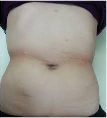 Maybe you would like to learn more about one of these? Reduced Port Endo Laparoscopic Surgery Using Umbilical Zigzag Incision For Concomitant Operations A Case Series Sciencedirect