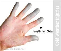 Cold Weather Injuries Tissue Freezing Prevention Cold Weather Health Watch Cold