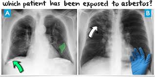 Diagnosis of asbestosis based upon either: Asbestos Xray