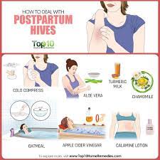 How To Deal With Postpartum Hives | Top 10 Home Remedies