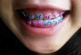 Check spelling or type a new query. Why The Fake Braces Trend May Be Dangerous For Users Upi Com