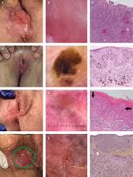 Where can people find more information about lichen sclerosus and other related conditions? Vulvamalignome Eine Interdisziplinare Betrachtung Wohlmuth 2019 Jddg Journal Der Deutschen Dermatologischen Gesellschaft Wiley Online Library