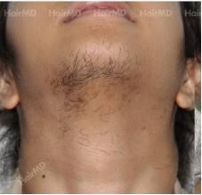 The average cost of laser hair removal is $875, according to 1,885 realself member reviews. Laser Hair Removal Cost For Chin And Cheeks Hairmd Pune